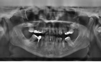 upala-zubnog-mesa-zubi